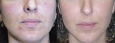 Peeling enzymatyczny