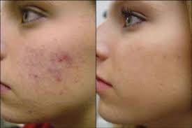 Peeling kwasem migdałowym