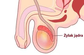 Żylaki jąder